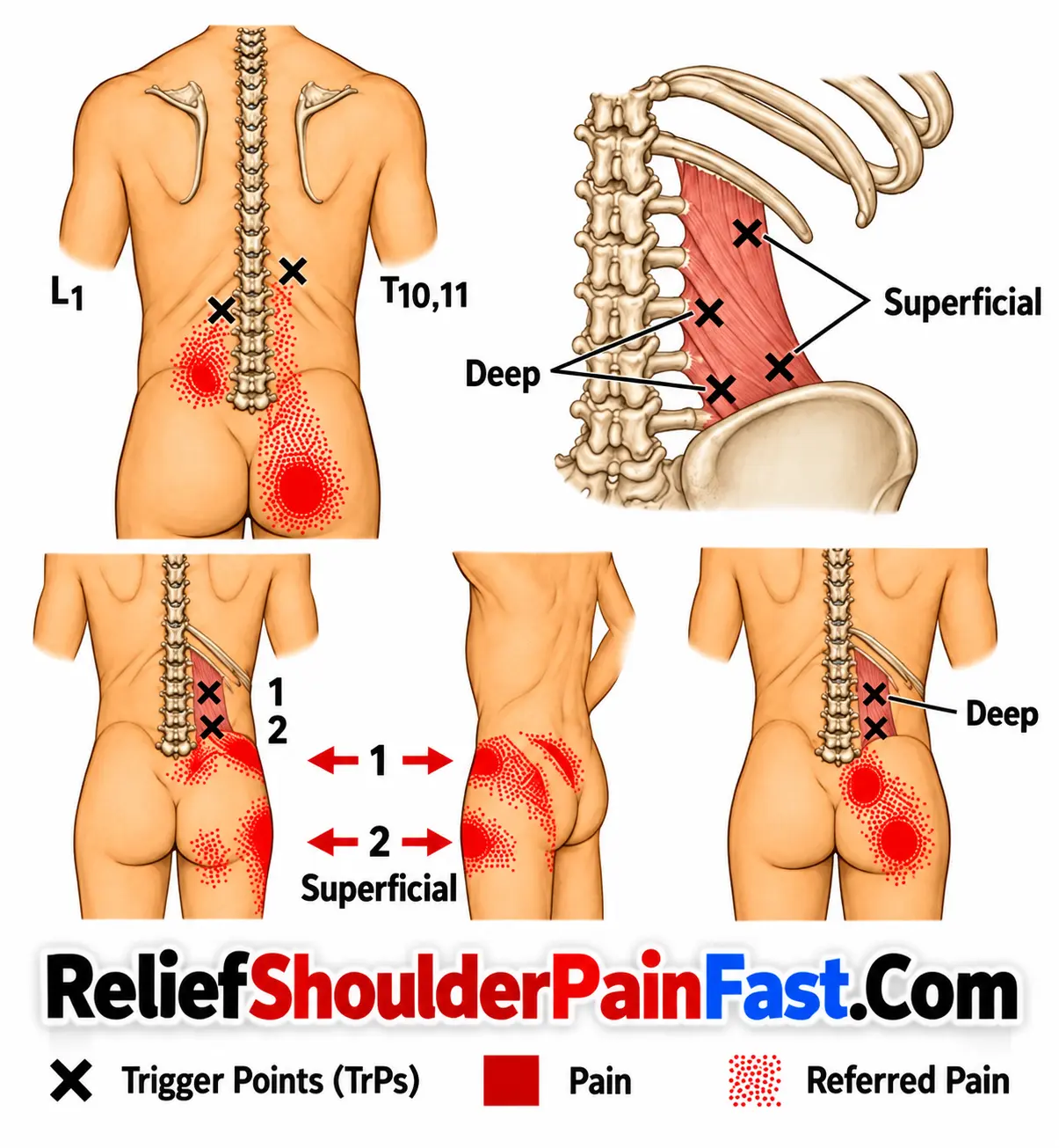 lower back pain  and referred pain