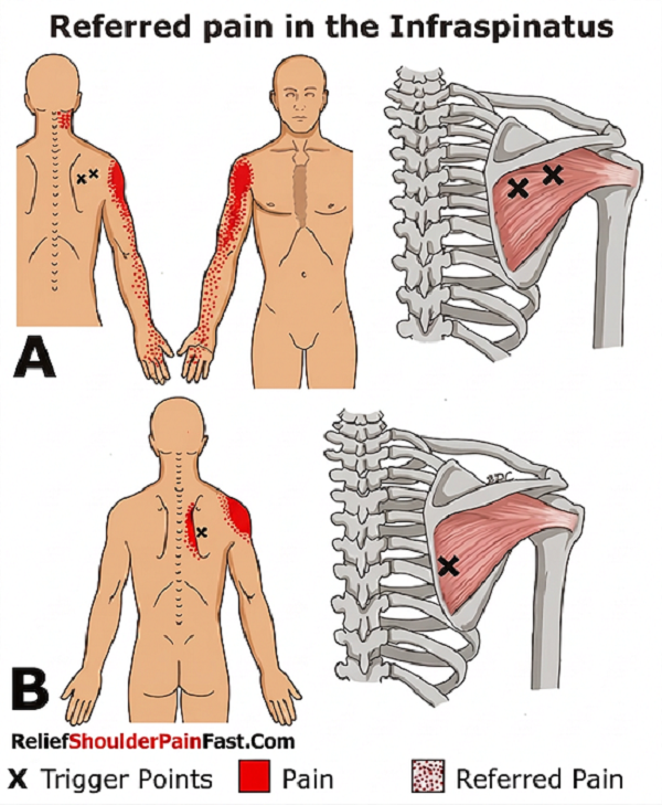 Infraspinatus and referred pain