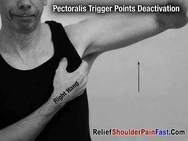 Locating pectoralis major trigger points