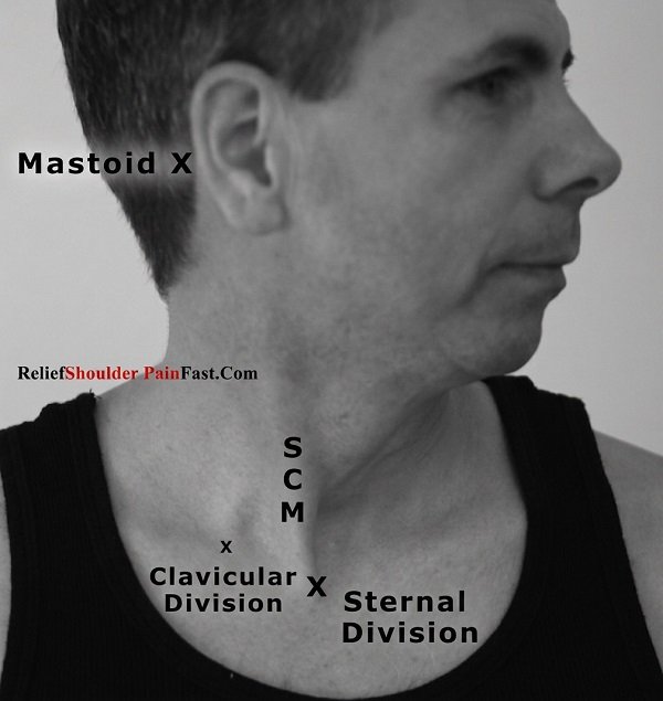 Location of the sternocleidomastoid muscle