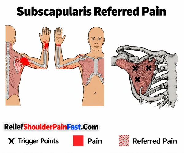 Subscapularis muscle referred pain pattern